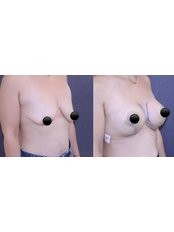 Breast Lift With Implants - TWT Health