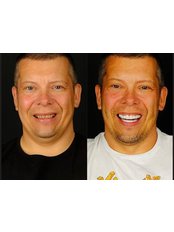Hollywood Smile with Porcelaine Crowns - TWT Health