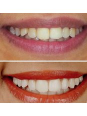 Teeth Whitening - Stoma Diş Polikliniği
