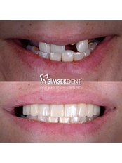 Porcelain Crown - Simsekdent Oral And Dental Health Clinic