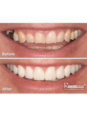 Zirconia Crown - Simsekdent Oral And Dental Health Clinic
