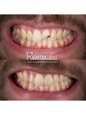 Fillings - Simsekdent Oral And Dental Health Clinic