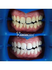 Teeth Whitening - Simsekdent Oral And Dental Health Clinic