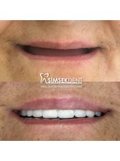 All-on-4 Dental Implants - Simsekdent Oral And Dental Health Clinic