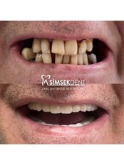 Dentures - Simsekdent Oral And Dental Health Clinic