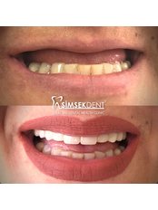 All-on-6 Dental Implants - Simsekdent Oral And Dental Health Clinic