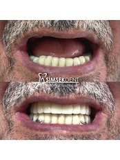 Flexible Partial Dentures - Simsekdent Oral And Dental Health Clinic