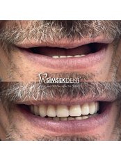 Full Dentures - Simsekdent Oral And Dental Health Clinic
