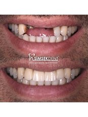 Porcelain Crown - Simsekdent Oral And Dental Health Clinic