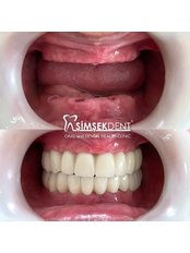 All-on-4 Dental Implants - Simsekdent Oral And Dental Health Clinic