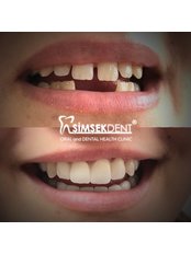 Zirconia Crown - Simsekdent Oral And Dental Health Clinic