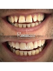 Hollywood Smile - Simsekdent Oral And Dental Health Clinic