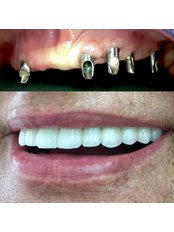 Zirconia Crown - Cosmetic Dentists of Istanbul