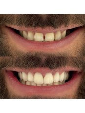 Hollywood Smile - Cosmetic Dentists of Istanbul
