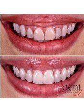 Hollywood Smile - Dent Anatomy Oral and Dental Health Central Hospital