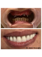 All-on-4 Dental Implants - Dt. Ayten Kocaoglu