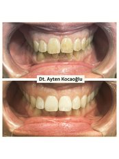 Teeth Whitening - Dt. Ayten Kocaoglu