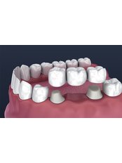Dental Bridges - MedicalİST