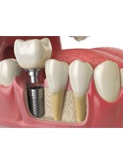 Dental Implants - MedicalİST