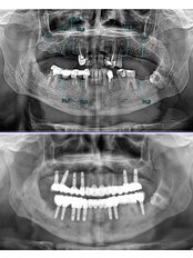 Dental X-Ray - MedicalİST