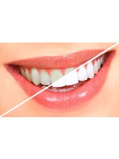 Teeth Whitening - MedicalİST