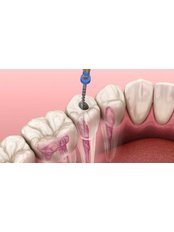 Root Canals - MedicalİST