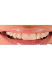 Dental Laminates - Tuncer Dental Cli̇ni̇c
