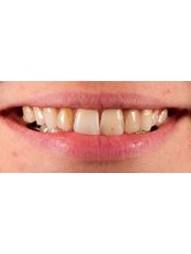 Dental Laminates - Tuncer Dental Cli̇ni̇c