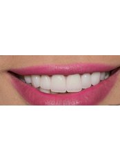 Dental Crowns - Tuncer Dental Cli̇ni̇c