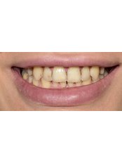 Dental Crowns - Tuncer Dental Cli̇ni̇c