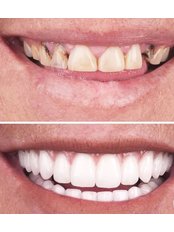 Dental Crowns - Dentbul Dental Clinic