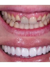 Veneers - Dentbul Dental Clinic