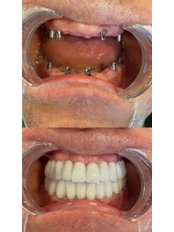 Dental Implants - Dentbul Dental Clinic