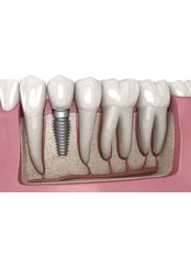 Dental Implants - Dentapolitan Ümraniye