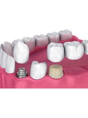 Dental Crowns - Dentapolitan Ümraniye