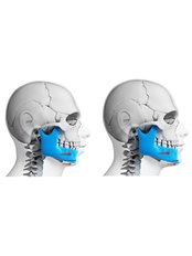 Orthognathic Surgery - Dentapolitan Ümraniye