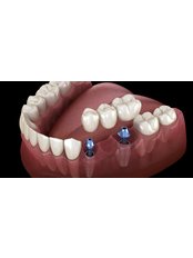 Dental Implants - Dentapolitan Ümraniye
