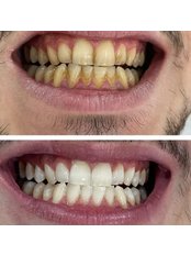 Teeth Whitening - Oxygen Dental Clinic