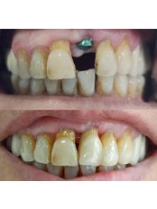 Dental Implants - Oxygen Dental Clinic