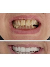 Zirconia Veneer - Oxygen Dental Clinic