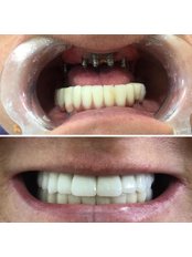 Dental Implants - Vira Denta