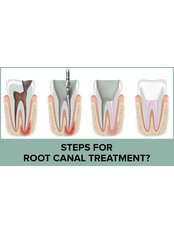 Root Canals - Dental Service