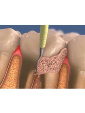 Gingivitis Treatment - Dental Service