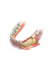 Bone Graft - Dental Service