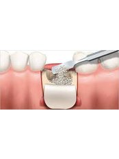 Bone Graft - Dental Service