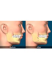 Orthognathic Surgery - Dental Service