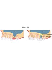 Sinus Lift - Dental Service