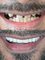 Eliz Dental Clinic - Eliz Dental Clinic - Zirconium Crowns Before&After 