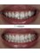 Luminous Dentacare - Sometimes small detail can solve weighty problem. (Aesthetic Filling) 