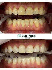 In Clinic Laser Teeth Whitening - Luminous Dentacare